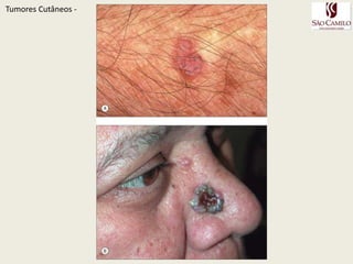 CBC NodularTumoresCutâneos - A – Pápulaperlácea com telangiectasias na região infraorbitalcheekB – Apresentação ClássicaBorda perlácea com centro ulcerado e crosta hemática no cantus medial.C – Placa perlácea, lesão mais evolida.B - 