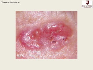 TumoresCutâneos - 
