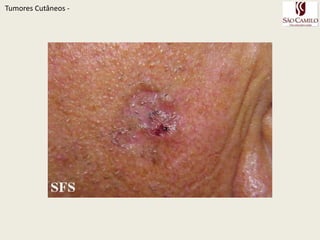 TumoresCutâneos - 