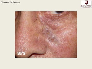 TumoresCutâneos - 