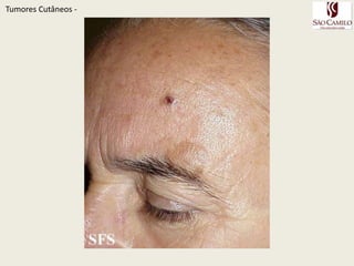 TumoresCutâneos - 