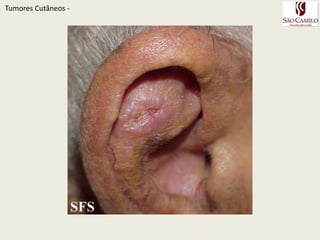 TumoresCutâneos - 