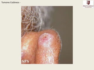 TumoresCutâneos - 