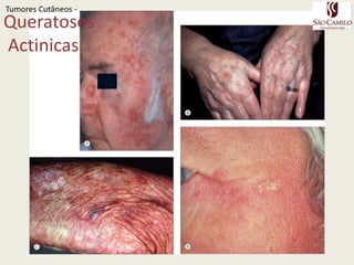 QueratosesActinicasLesão confinada a epiderme de queratinócitos atípicosLesão pré-malignaTransformação 13-20 % em 10 anos se não tratadoPresentes em áreas de fotodano – face, pescoço, tronco, mmssidososQC: Placa eritematosa com crosta branca a amareloTumoresCutâneos - 