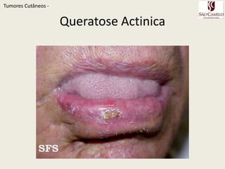 TumoresCutâneos - QueratosesActinicas