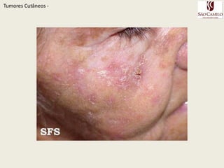 QueratoseActinicaTumoresCutâneos - 