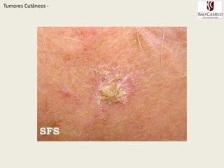 TumoresCutâneos - 
