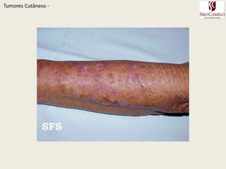 TumoresCutâneos - 