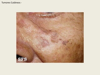 TumoresCutâneos - 
