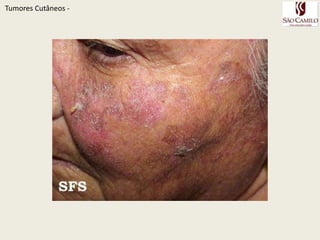 TumoresCutâneos - 