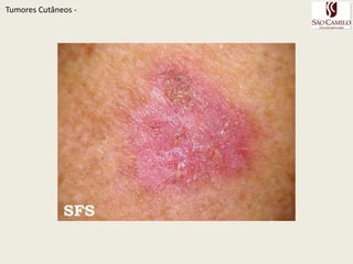 TumoresCutâneos - 