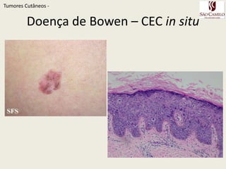 TumoresCutâneos - 