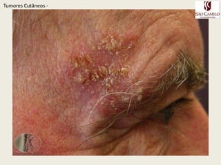 Doença de Bowen – CEC in situTumoresCutâneos - 