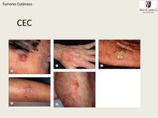 Características Clinicas - CECTumoresCutâneos - Neoplasia maligna de células queratinizadas da epidermeRadiação Ultravioleta cumulativa é o mais importante fator de risco.Quando associado a RUV - risco de metástase é 5%Lesão precursora:queratoseactínica com risco de 12% de transf em CEC  ulceras crônicas