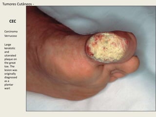 TumoresCutâneos - CEC
