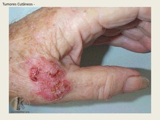 TumoresCutâneos - 