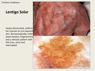 TumoresCutâneos - Melanoma MalignoClínica - ABCDE