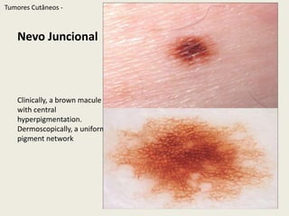 Lentigo Solarharplydemarcated, uniform, tan macules onsun-exposedskin. Dermoscopically, moth-eatenborders, fingerprinting, and a reticular patternwiththinlines, short andinterruptedTumoresCutâneos - 