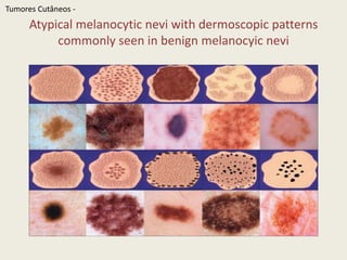 Nevo JuncionalClinically, a brown macule with central hyperpigmentation. Dermoscopically, a uniformpigment network TumoresCutâneos - 