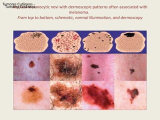 Atypicalmelanocyticneviwithdermoscopicpatternscommonlyseen in benignmelanocyicneviTumoresCutâneos - 