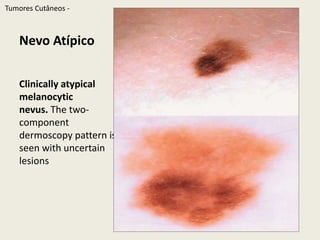 Atypicalmelanocyticneviwithdermoscopicpatternsoftenassociatedwith melanoma.  From top to bottom, schematic, normal illumination, anddermoscopyTumoresCutâneos - TumoresCutâneos - 