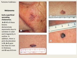 Nevo AtípicoClinicallyatypicalmelanocyticnevus. Thetwo-componentdermoscopypattern is seenwithuncertainlesionsTumoresCutâneos - 