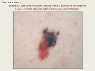 MelanomaTumoresCutâneos - Early superficial spreading melanomas. A–D Alloftheselesionsdemonstrateasymmetrydue to variation in colorandirregularity in outline. In addition, there is pinkdiscoloration in D. A–C werelessthan 0.5 mm in thicknessand D was 0.8 mm