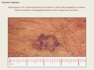 Superficial spreading melanoma arisingwithin a compoundmelanocyticnevus. Note the irregular outlineandvariablepigmentation. TumoresCutâneos - 