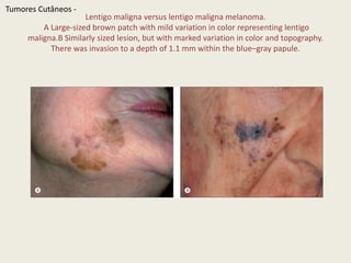  Minimallyinvasive melanoma (Breslowdepth 0.3 mm) with a diameterlessthan 5 mm. TumoresCutâneos - 