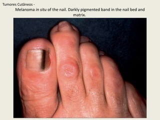 Lentigo maligna versus lentigo maligna melanoma.A Large-sizedbrownpatchwithmildvariation in colorrepresentinglentigo maligna.B Similarlysizedlesion, butwithmarkedvariation in colorandtopography. Therewasinvasion to a depthof 1.1 mm withintheblue–graypapule.TumoresCutâneos - 