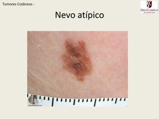 Melanoma in situ ofthenail. Darklypigmentedband in thenailbedandmatrix. TumoresCutâneos - 