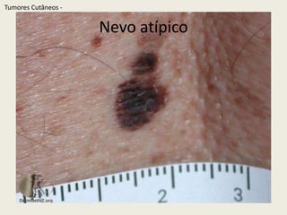 Nevo atípicoTumoresCutâneos - 