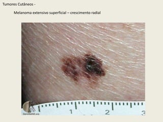 Nevo atípicoTumoresCutâneos - 