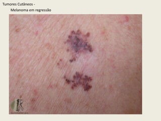 TumoresCutâneos - Melanoma extensivo superficial – crescimento radial