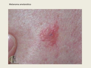 TumoresCutâneos - Melanoma em regressão