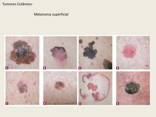 Melanoma amelanótico