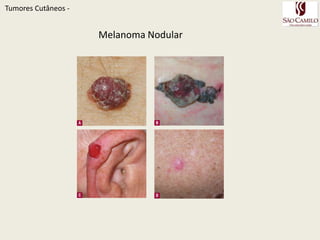 TumoresCutâneos - Melanoma superficial