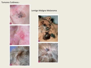 TumoresCutâneos - Melanoma Nodular