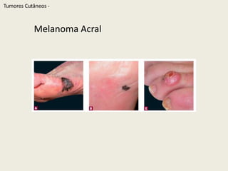 TumoresCutâneos - LentigoMaligno Melanoma