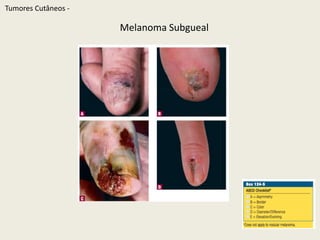 TumoresCutâneos - Melanoma Acral