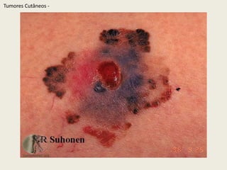 TumoresCutâneos - 