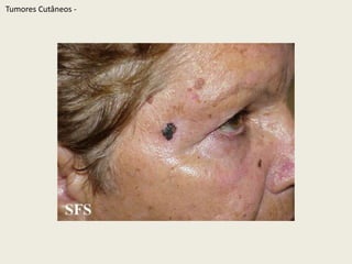 TumoresCutâneos - 