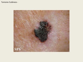 TumoresCutâneos - 