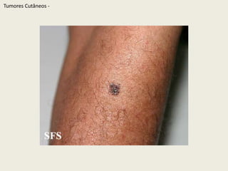 TumoresCutâneos - 