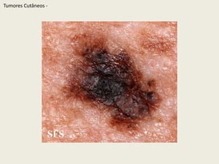 TumoresCutâneos - 