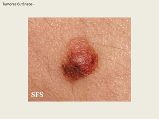 TumoresCutâneos - 