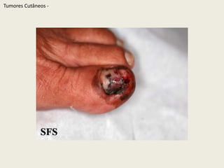 TumoresCutâneos - 