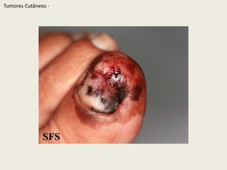 TumoresCutâneos - 