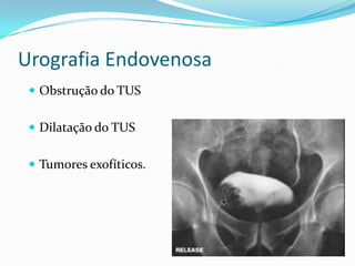 Urografia Endovenosa
  Obstrução do TUS


  Dilatação do TUS


  Tumores exofíticos.
 