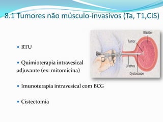 8.1 Tumores não músculo-invasivos (Ta, T1,CIS)


    RTU


    Quimioterapia intravesical
   adjuvante (ex: mitomicina)

    Imunoterapia intravesical com BCG


    Cistectomia
 